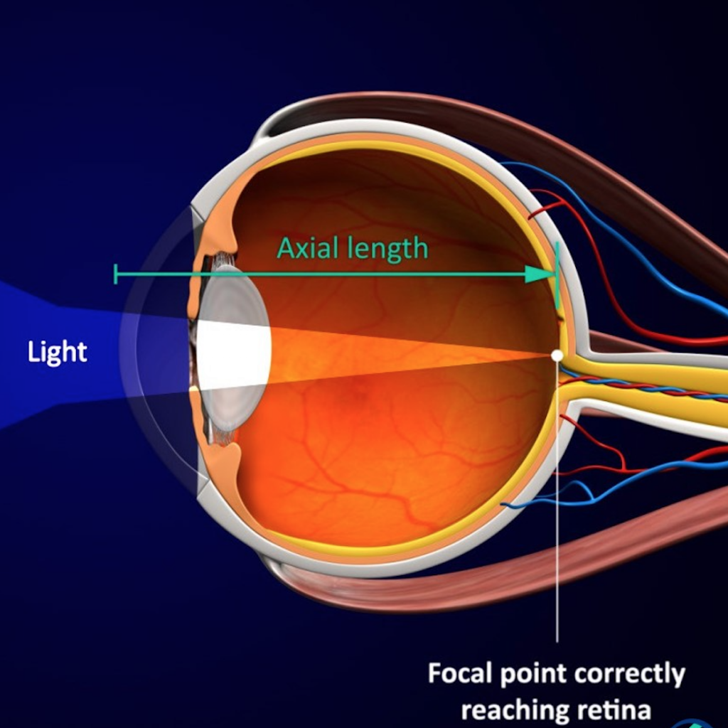 Étape 1 : Dans un œil normal, la lumière traverse le cristallin et le point focal atteint correctement la rétine.